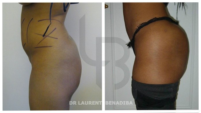 Clinical case: patient wishing to increase the buttocks without prosthesis. Injection of 400 ml per buttock of fat after liposuction of the hips