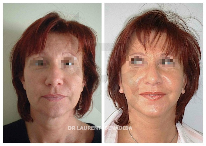 53 year old woman, first cervico-facial lifting. Results after 15 days with slight persistant edema (swelling), but resumption of social life. This 53 yo patient wanted to treat her full face with: First cervico-facial lifting, Botox and Hyaluronic acid injections (1 zone). 