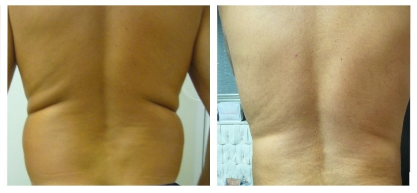 43-year-old man, Sportsman with excess fat on the abdomen and wrists, love without being overweight. Results at 2 months