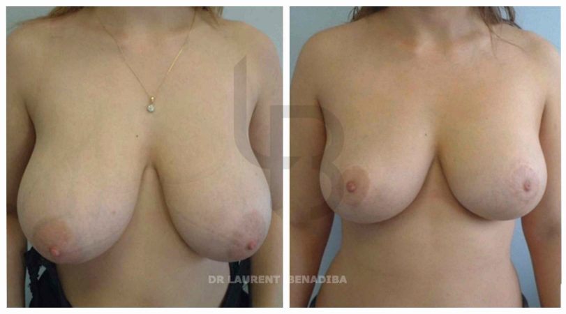 Significant breast hypertrophy (100 D), reduction by technique with inverted T scar.
