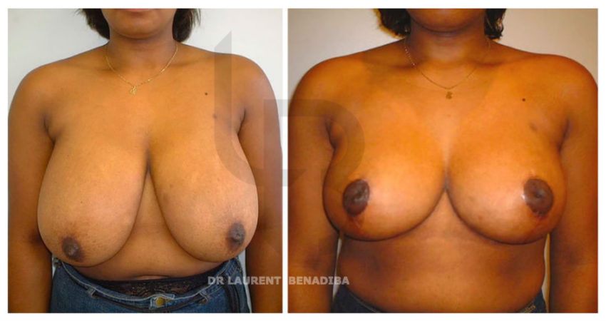 Very significant breast hypertrophy (100 E) on pigmented skin, reduction by technique with inverted T scar. Severe ptosis with Thorek technique.