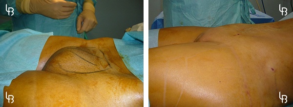 Mons Pubis Reduction, Vulvar Lipoplasty, Mons Pubis Liposuction